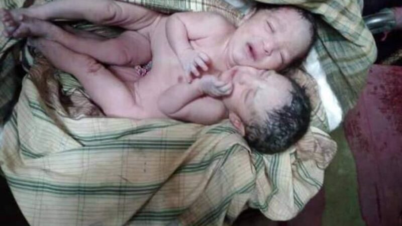 চিকিৎসার সামর্থ নেই পরিবারের, গৌরনদীতে জোড়া লাগানো জমজ কন্যা সন্তানের জন্ম